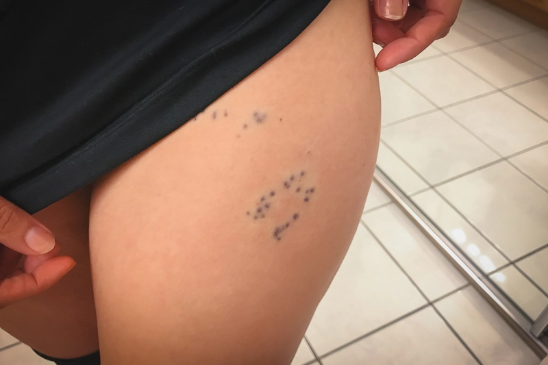 Marca dos espinhos do ouriço do mar que ficou na perna da Tatá, durante mergulho com as raias mantas no Havaí